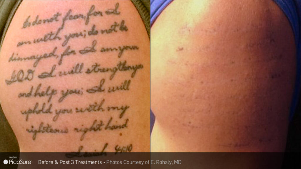 How NAAMA offers the latest in laser tattoo removal technology